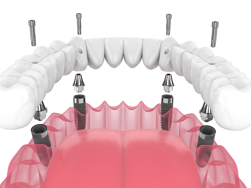 Dental Implants