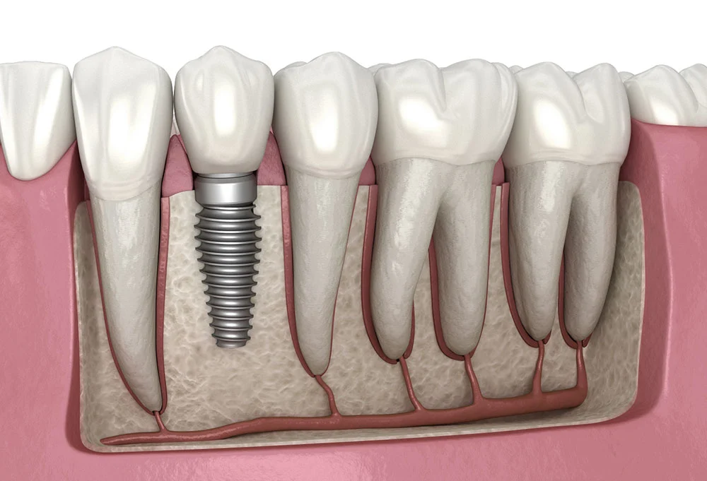 Dental implant illustration