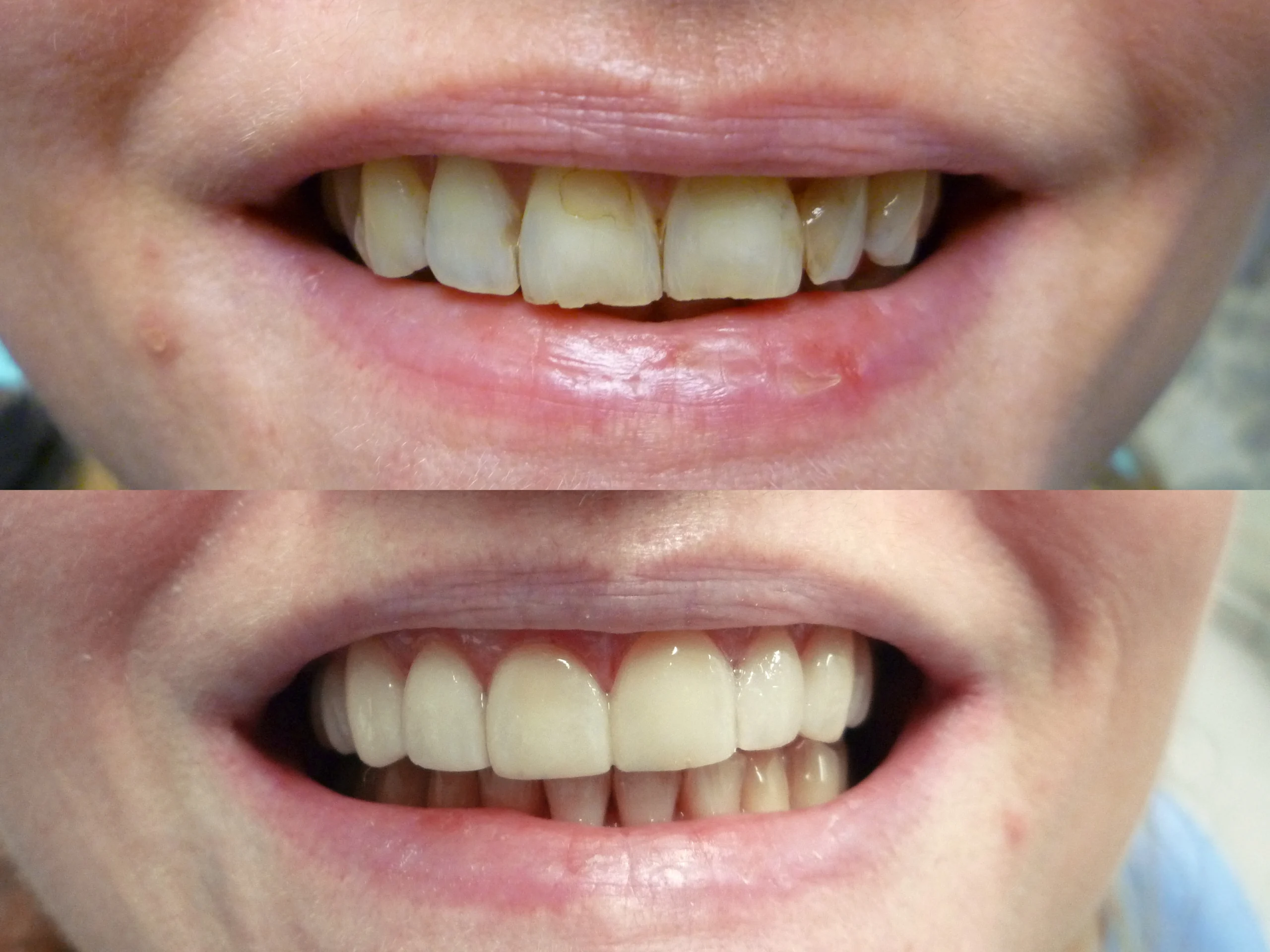 two smiling mouth that shows her/his teeth for showing before and after of dental treatment