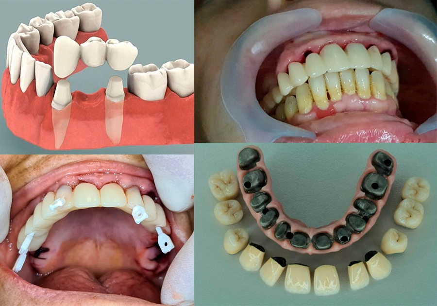 4 different dental treatment and two mouth